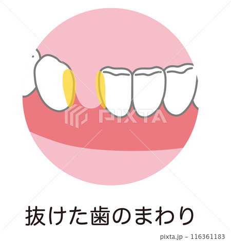 抜けた歯のまわりまわりに溜まった歯垢 歯磨き 磨き残し 抜けた歯のまわりまわりに溜まった歯垢 歯磨き 磨き残し 116361183