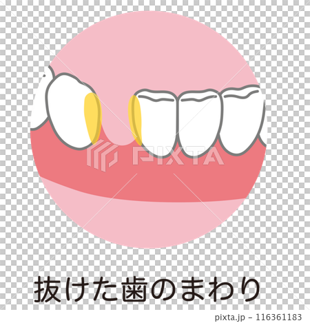 抜けた歯のまわりまわりに溜まった歯垢 歯磨き 磨き残し 抜けた歯のまわりまわりに溜まった歯垢 歯磨き 磨き残し 116361183
