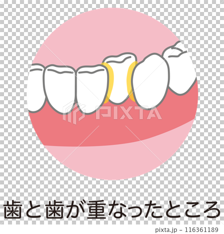 Plaque that has accumulated between teeth, tooth brushing, unbrushed areas 116361189