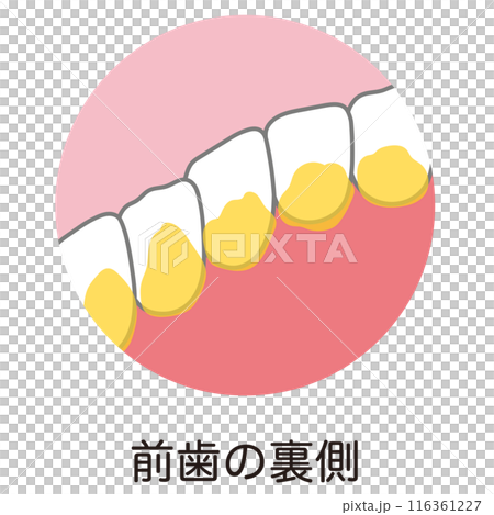 前牙背積聚的牙菌斑，是刷牙時殘留的 116361227