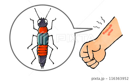 やけど虫の体液で炎症した腕 やけど虫の体液で炎症した腕 116363952