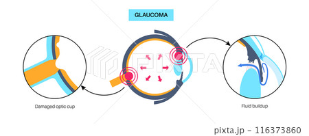 Glaucoma eye disease 116373860
