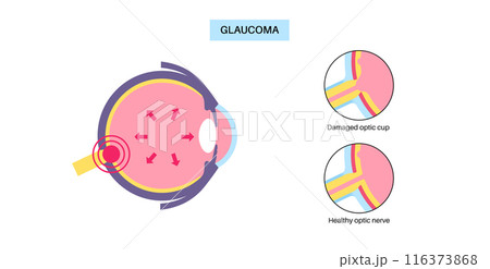 Damaged optic cup 116373868
