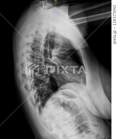 X-ray of thoracic spine. Lateral view. Vertebrae and intervertebral joints of chest. Healthy backbone anatomy radiography image X-ray of thoracic spine. Lateral view. Vertebrae and intervertebral joints of chest. Healthy backbone anatomy radiography image 116375042