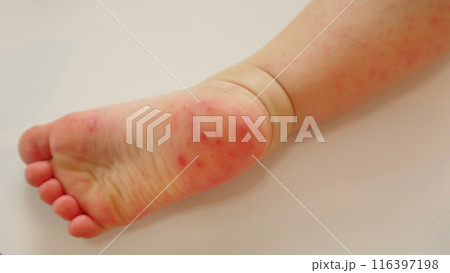 手足口病で発疹のできた幼児の足の裏 116397198