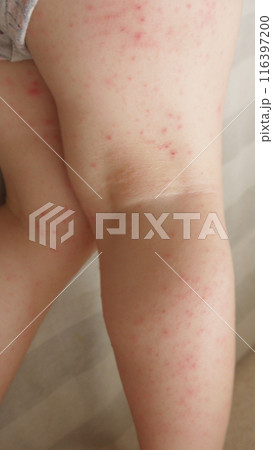 手足口病で発疹のできた幼児の膝の裏 116397200