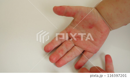手足口病で発疹のできた幼児の手のひら 116397201