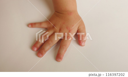 手足口病で発疹のできた幼児の手 116397202