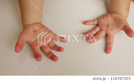 手足口病で発疹のできた幼児の両手 116397203