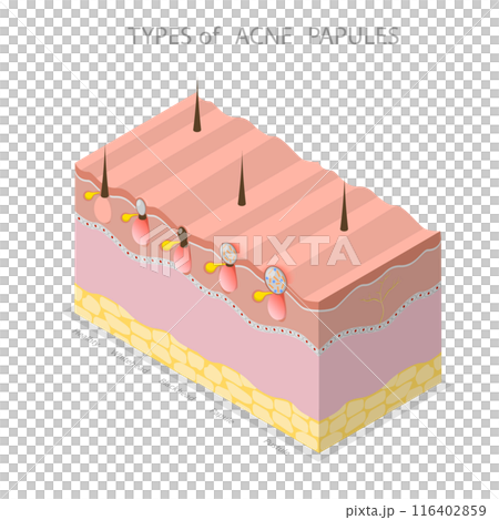 3D Isometric Flat Illustration of Types Of Acne Papules, Skin Problems 3D Isometric Flat Illustration of Types Of Acne Papules, Skin Problems 116402859