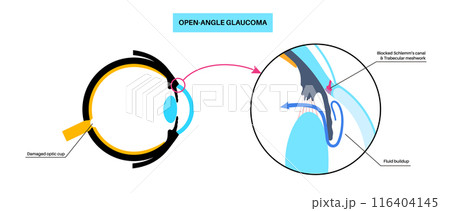 Glaucoma eye disease Glaucoma eye disease 116404145