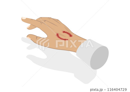 3D Isometric Flat  Illustration of Dog Bite, Rabies Virus 116404729