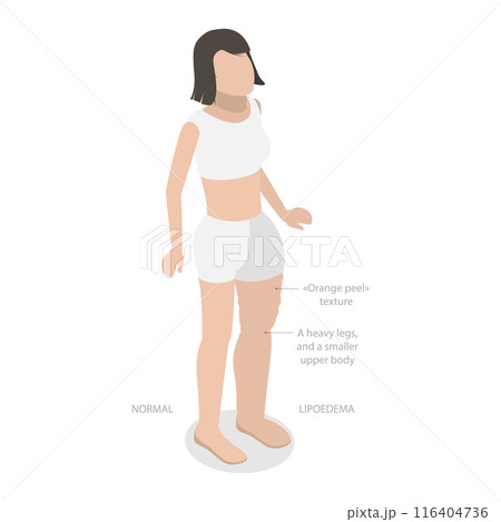 3D Isometric Flat  Illustration of Lipoedema, Overweight Issues 116404736