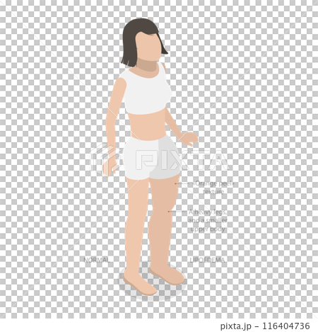 3D Isometric Flat  Illustration of Lipoedema, Overweight Issues 116404736