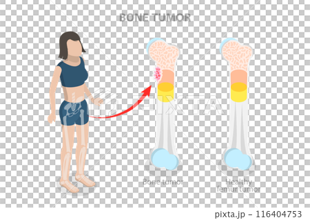 3D Isometric Flat  Illustration of Bone Tumor, Orthopedic Problem 116404753