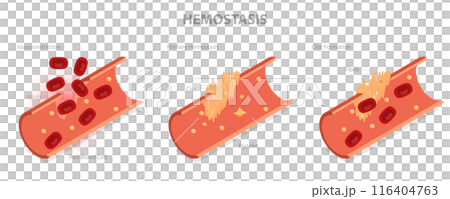 3D Isometric Flat Illustration of Hemostasis, Wound Healing Process 3D Isometric Flat Illustration of Hemostasis, Wound Healing Process 116404763