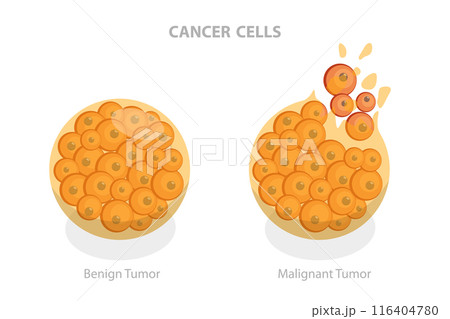 3D Isometric Flat  Illustration of Cancer Cells, Tumor Development 116404780