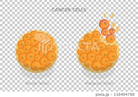 3D Isometric Flat  Illustration of Cancer Cells, Tumor Development 116404780