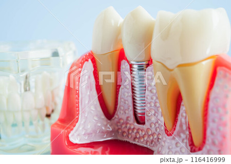 Artificial tooth roots dental implant into jaw, Root canal model for dentist. Artificial tooth roots dental implant into jaw, Root canal model for dentist. 116416999