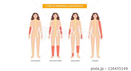 Peripheral neuropathy medical poster Peripheral neuropathy medical poster 116435149