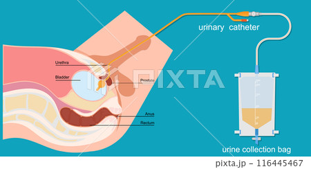 Urinary catheter in the male body with urinary bag. 116445467