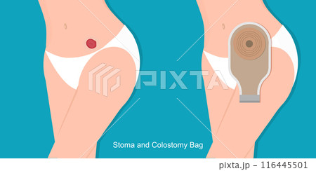 A colostomy in female is a surgical procedure. 116445501