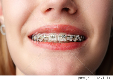 Young woman with dental braces close up 116471214