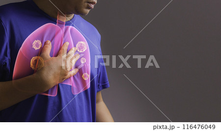 Lung cancer. 3d x-ray concept 116476049