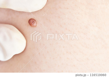 Woman examing her abnormal mole. Dermatology procedure. Doctor checking 116510060