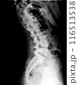 X-ray of lumbar spine and pelvis. Lateral view. Vertebrae and intervertebral joints of lower back and coccyx. Healthy backbone anatomy radiography image 116513538