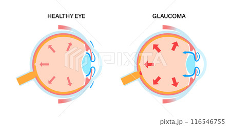 Glaucoma eye pressure 116546755