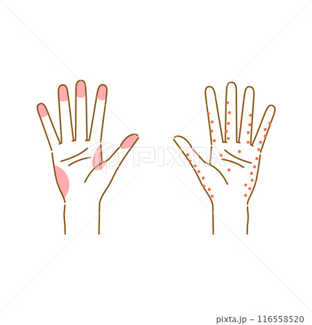 手湿疹と汗疱のよく発症する部位のイメージイラスト(女性の手) 手湿疹と汗疱のよく発症する部位のイメージイラスト(女性の手) 116558520