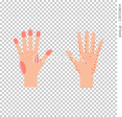 Illustration of common areas for hand eczema and sweat rash (female hands) 116558654
