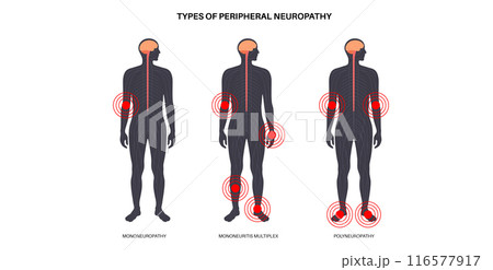 Peripheral neuropathy medical poster Peripheral neuropathy medical poster 116577917