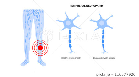 Peripheral neuropathy medical poster 116577920