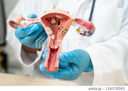 Uterus, doctor with anatomy model for study diagnosis and treatment in hospital. 116578565