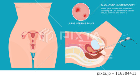 Diagnostic hysteroscopy is a minimally invasive procedure called a hysteroscope. 116584413
