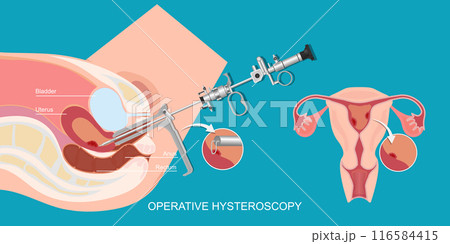 Operative hysteroscopy is a minimally invasive gynecological procedure. 116584415