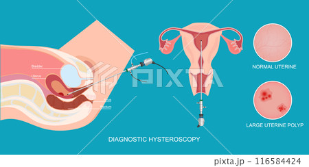 Diagnostic hysteroscopy is used to diagnose or treat problems of the uterus. Diagnostic hysteroscopy is used to diagnose or treat problems of the uterus. 116584424