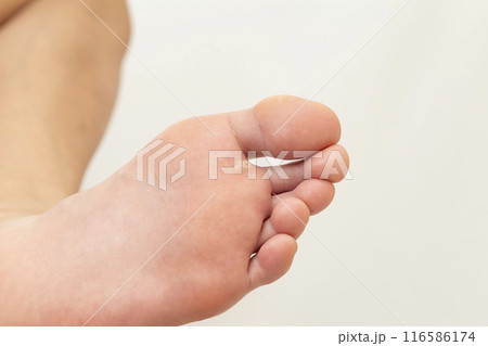 足裏にできたイボ　白バック 116586174