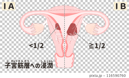子宮癌I期（第1期） 簡單易懂的日文插圖 116590760