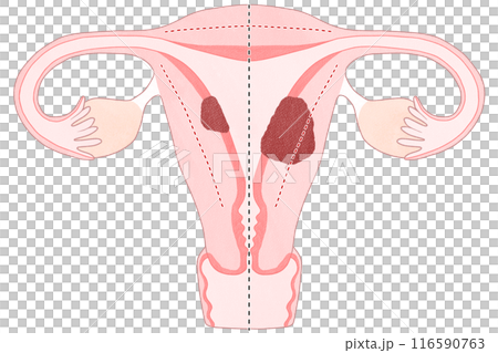 Stage I (1st stage) uterine cancer - easy-to-understand illustration 116590763