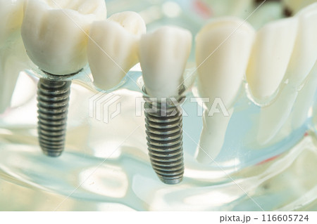 Dental implant, artificial tooth roots into jaw, root canal of dental treatment, gum disease, teeth model for dentist studying about dentistry. Dental implant, artificial tooth roots into jaw, root canal of dental treatment, gum disease, teeth model for dentist studying about dentistry. 116605724