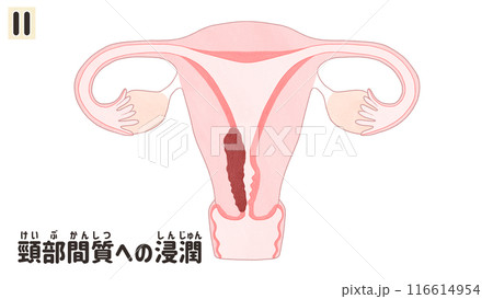子宮体がんステージⅡ(2期) わかりやすい日本語図解イラスト 子宮体がんステージⅡ(2期) わかりやすい日本語図解イラスト 116614954