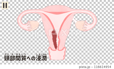 子宮体がんステージⅡ(2期) わかりやすい日本語図解イラスト 子宮体がんステージⅡ(2期) わかりやすい日本語図解イラスト 116614954