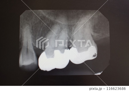 歯科用レントゲン写真　小臼歯大臼歯　被せ物 116623686