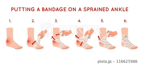 Applying elastic bandage to ankle. Foot injury. Soft tissues swelling. Medical care. First aid. Step by step instructions. Broken bone. Trauma treatment manual. Recent vector infographics Applying elastic bandage to ankle. Foot injury. Soft tissues swelling. Medical care. First aid. Step by step instructions. Broken bone. Trauma treatment manual. Recent vector infographics 116625986