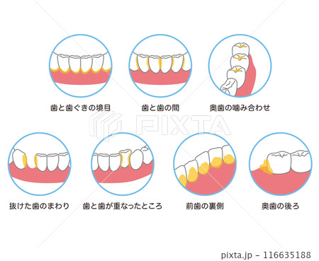 歯に溜まった歯垢 歯磨き 磨き残し 歯に溜まった歯垢 歯磨き 磨き残し 116635188