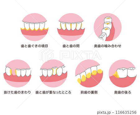 歯に溜まった歯垢 歯磨き 磨き残し 歯に溜まった歯垢 歯磨き 磨き残し 116635256