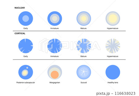 Cataract eye disease 116638023
